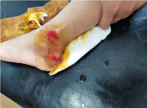 被车轮“咬”住！长春6岁男宝脚部创面深达筋膜