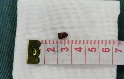 取个异物，为啥一定要全麻？