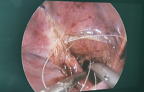 发病率5‰，长春4岁女娃因这病腹痛1个月