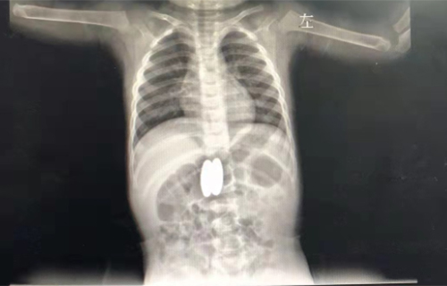 感冒检查，意外发现胃肠竟吸在一起了