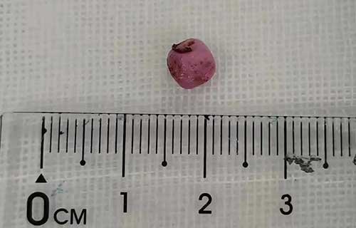 年后3例了，带孩子出去玩千万小心