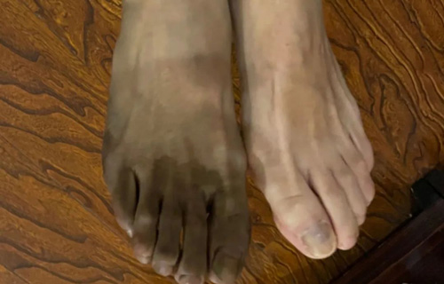 战疫 | 54岁抗疫天使的“黑白脚”