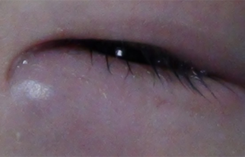 泪道置管，让宝宝不再满含泪水