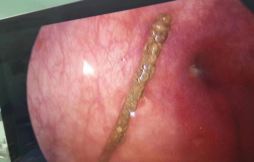 吉林一13岁男孩将4厘米缝衣针插入尿道！