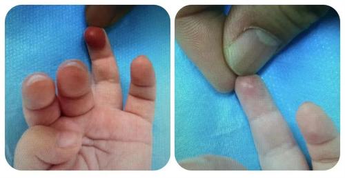 谈“瘤”不必色变，儿童血管瘤可以这样治！