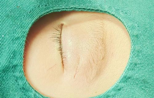 2岁幼儿眼部手术，手术切口“隐形”啦……