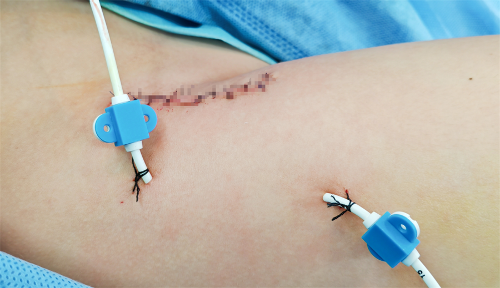 巧用自主研发导流管，长春儿童医院助6岁孩童跨越“髋关”