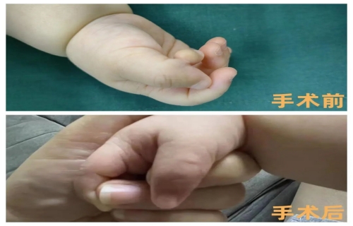 六个月宝宝“特殊多指”，啪啪网
巧解难题