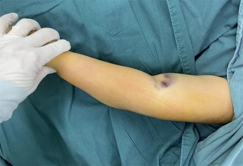 小胖墩重度骨折，在这里居然4天出院！