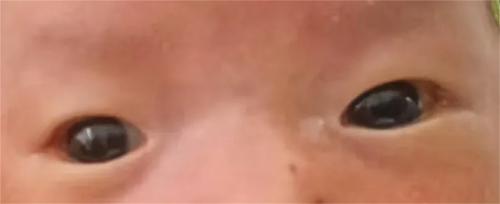 刚出生24天的小宝宝被眼病困扰，在这里3天治愈出院