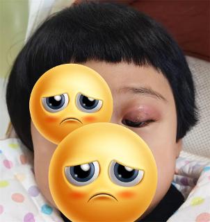 无痕切除小肿物，解决眼部大麻烦