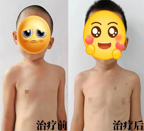 儿童斜颈，在这里能够微创治疗！