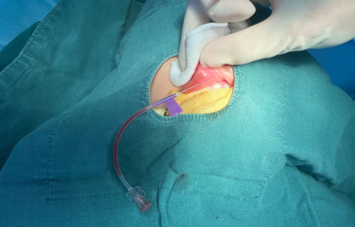 不开刀的血管焕新术：啪啪网
DSA技术开启微创介入治疗新纪元