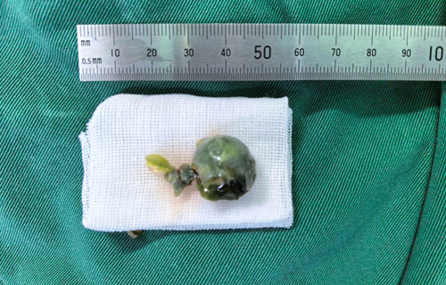 肿物or异物？8岁女童鼻塞1年加重，儿医揪出伪装“真凶”