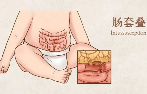 腹部包块、吐奶、果酱便……警惕小儿肠套叠