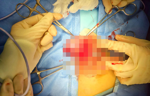 深夜生命保卫战：成功修复13岁少年破裂睾丸